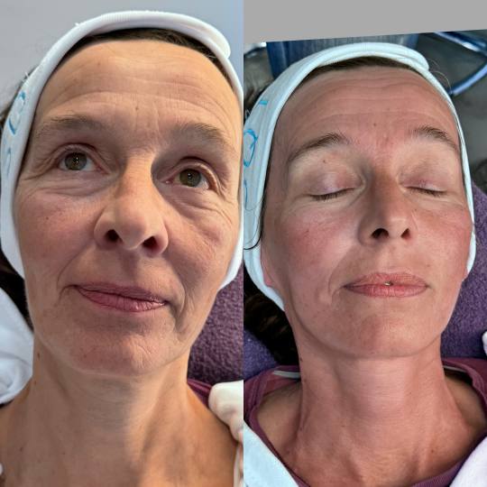 Luma Medic #zagreb Tretman lica SQT antiaging Ako želite odmah vidljivo smanjene bore i fine linije