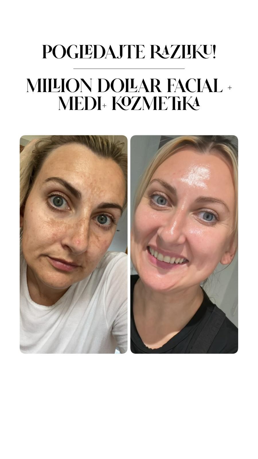 Una Victoria beauty concept #zadar Tretman lica Million dollar facial tretman