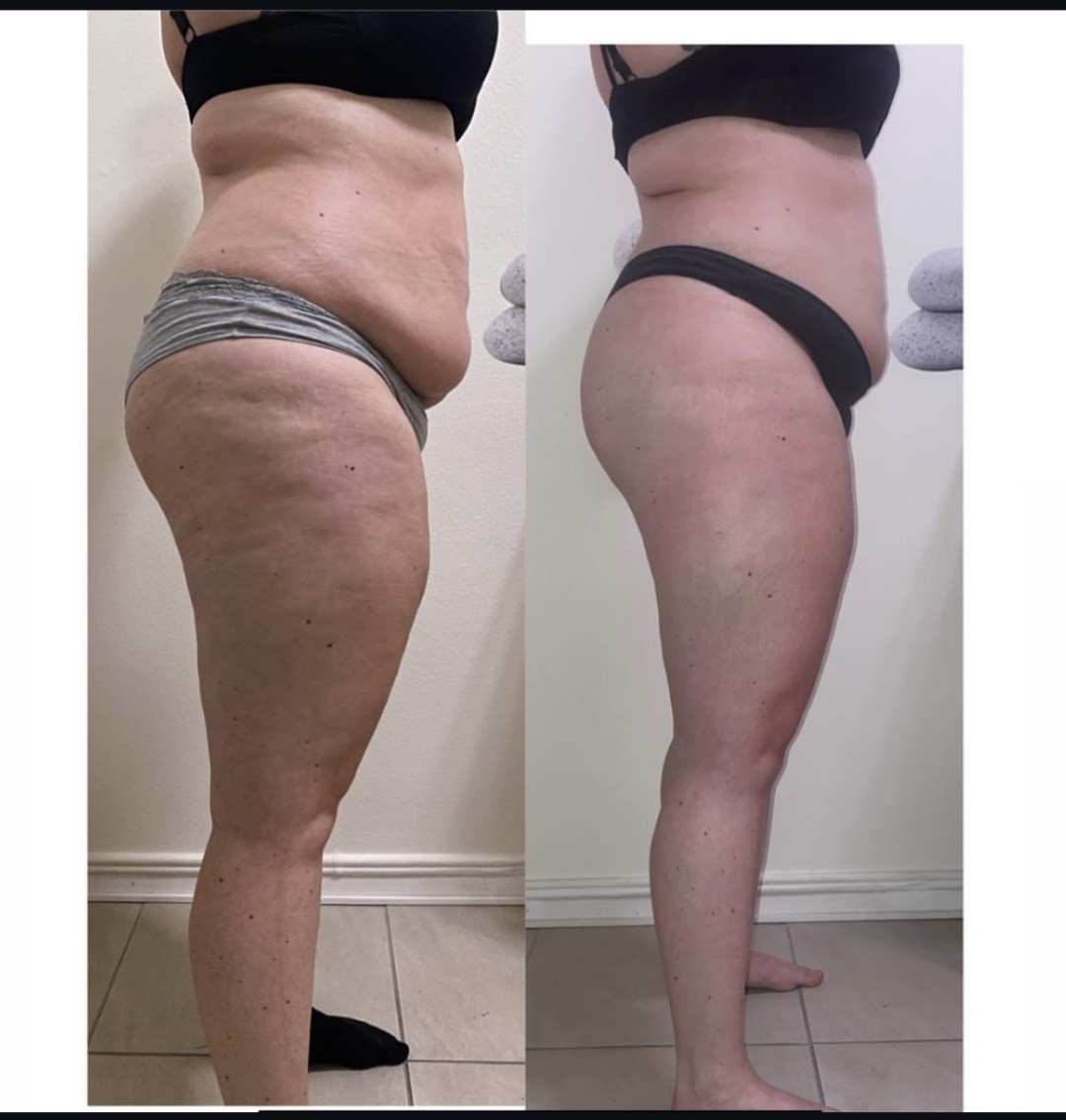 Nefertiti Studio #zagreb Anticelulit masaža Maderoterapija - cijelo tijelo