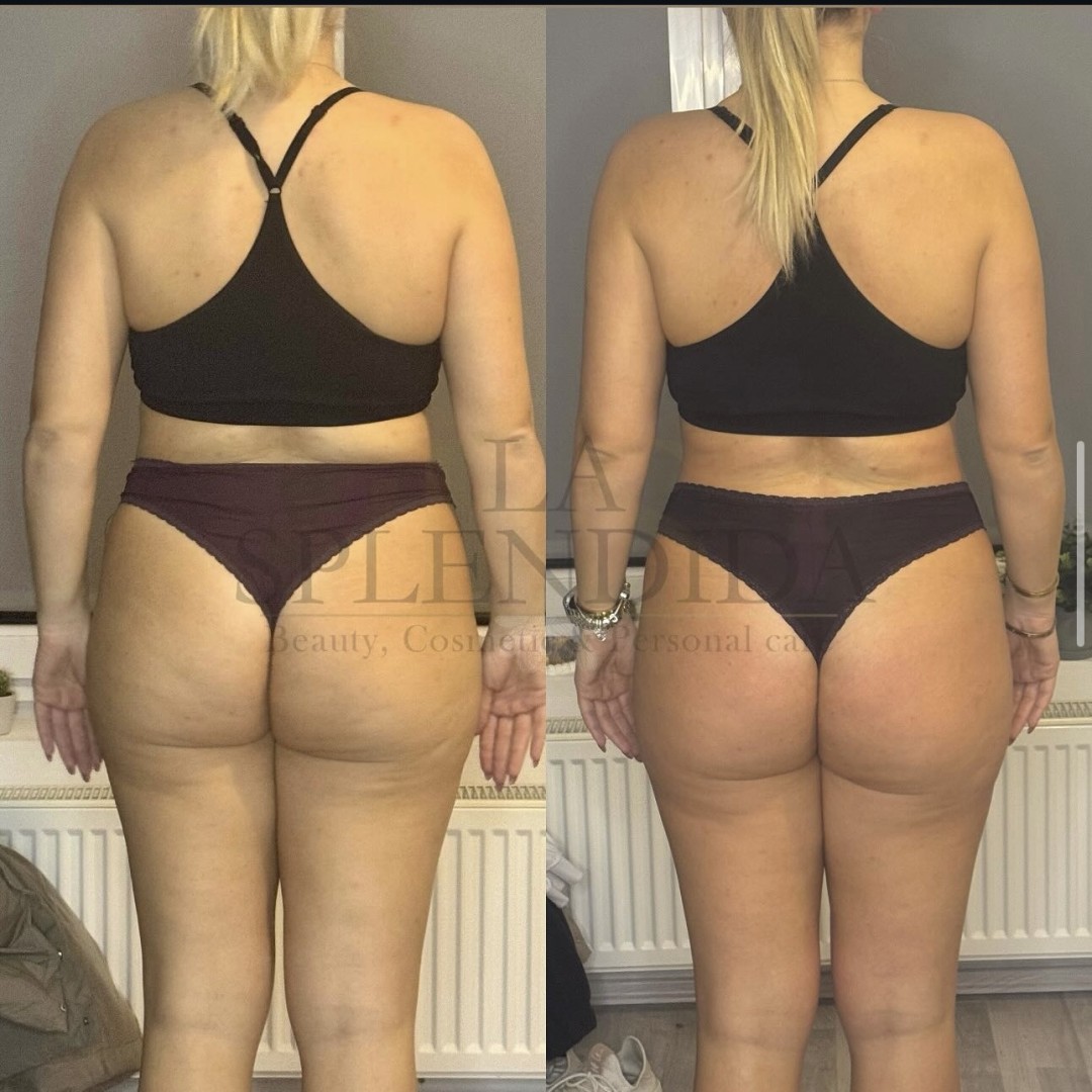 La Splendida #velika-gorica Tretmani tijela Brazilska maderoterapija - cijelo tijelo