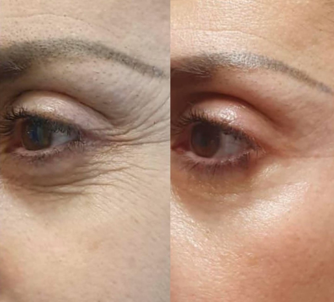 Spellar - Križ #kriz Tretmani regije oko očiju Plasma pen - uklanjanje bora oko očiju