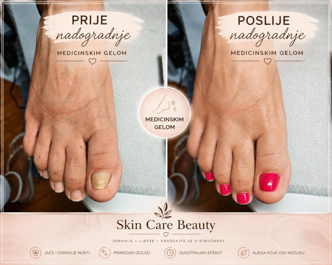 Skin Care Beauty #rijeka Nadogradnja noktiju Antifugal nadogradnja gljivičnih Noktiju