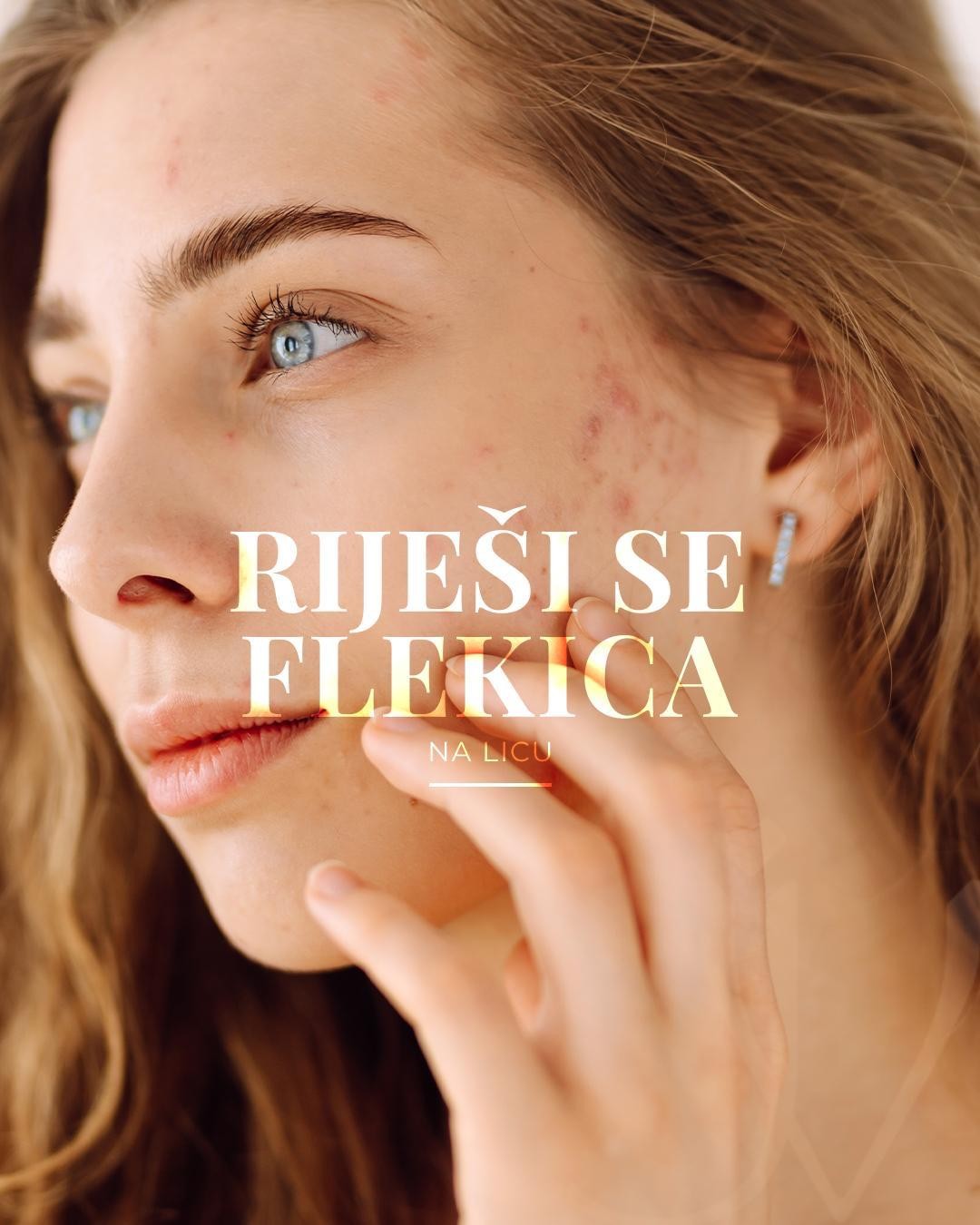 Una Victoria beauty concept #zadar Tretman lica Kemijski piling + dermaplaning tehnika