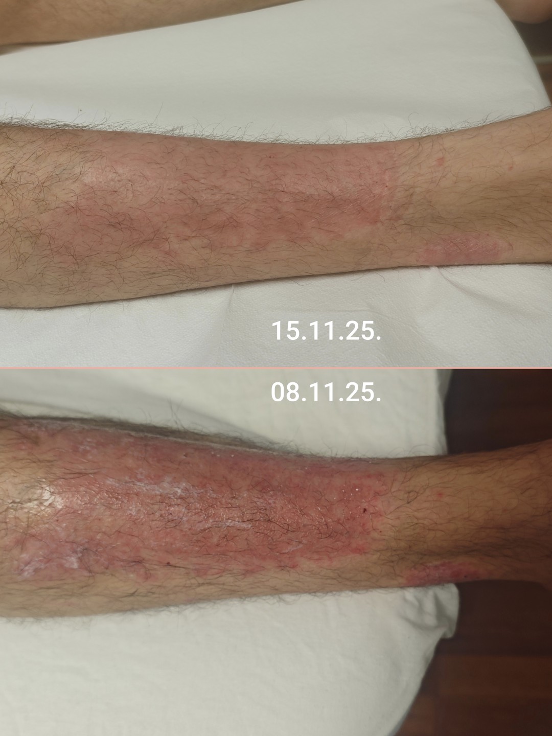 BioLaser Studio Rijeka #rijeka Tretmani tijela My ato liječenje + njega kože - izrazito osjetljiva koža