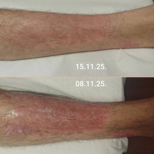 BioLaser Studio Rijeka #rijeka Tretmani tijela My ato liječenje + njega kože - izrazito osjetljiva