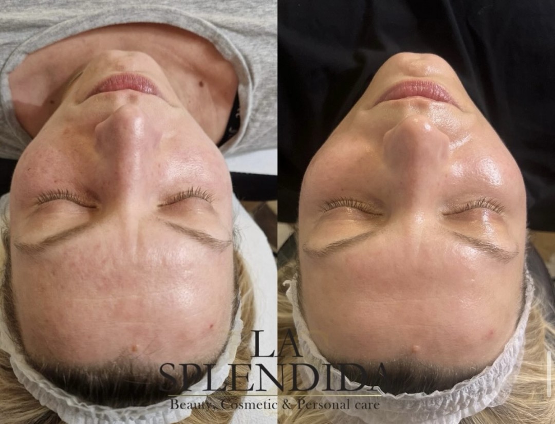 La Splendida #velika-gorica Tretman lica Tretman kologen nitima - lice