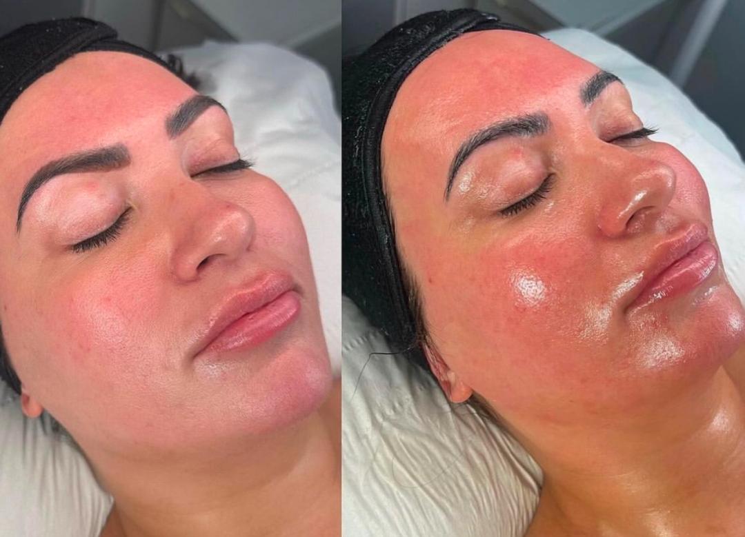 Perfect body beauty bar #zagreb Dermaroler i dermapen Dermapen - lice