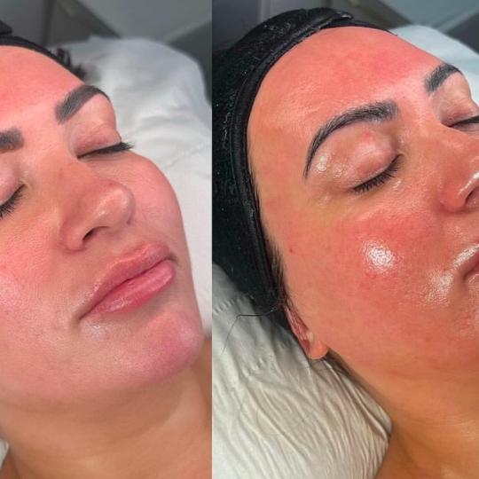 Perfect body beauty bar #zagreb Dermaroler i dermapen Dermapen - lice