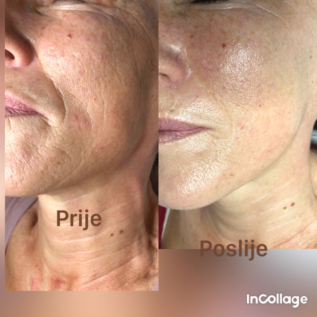 FeelUnique #zagreb Tretman lica Nana i Gaba lift therapy + microneedling - lifting / pomlađivanje