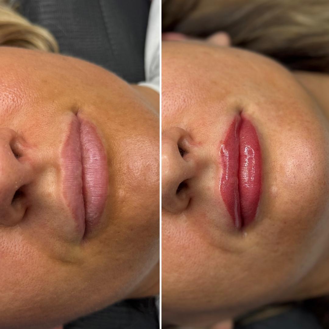 Trajna šminka - usne (sa korekcijom nakon 4-6 tjedana) - Anova Aesthetics, Zagreb Trajna šminka Lice Trajna šminka, Zagreb, Trešnjevka – jug