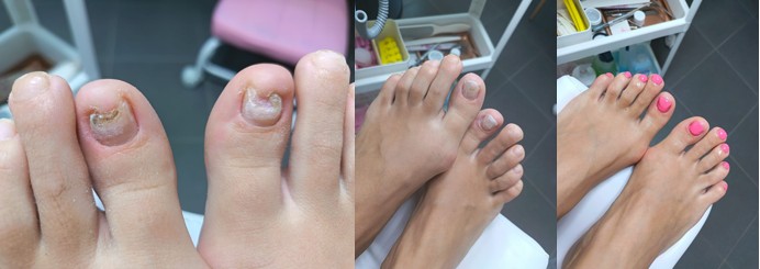 Rekonstrukcija nokta antifungalnim gelom 30' - Moje vrijeme, Zagreb Medicinska pedikura Nokti Medicinska pedikura, Zagreb, Trnje