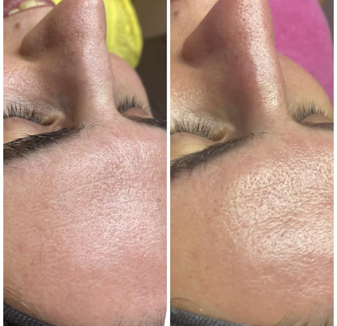 Nefertiti Studio #zagreb Tretman lica Hydrafacial Deluxe tretman lica