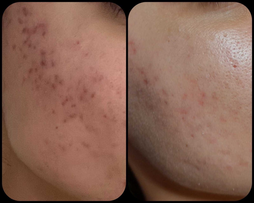 Dermapen - Microneedling - Natural, Rijeka Lifting / zatezanje kože Lice Lifting / zatezanje kože, Rijeka, Centar
