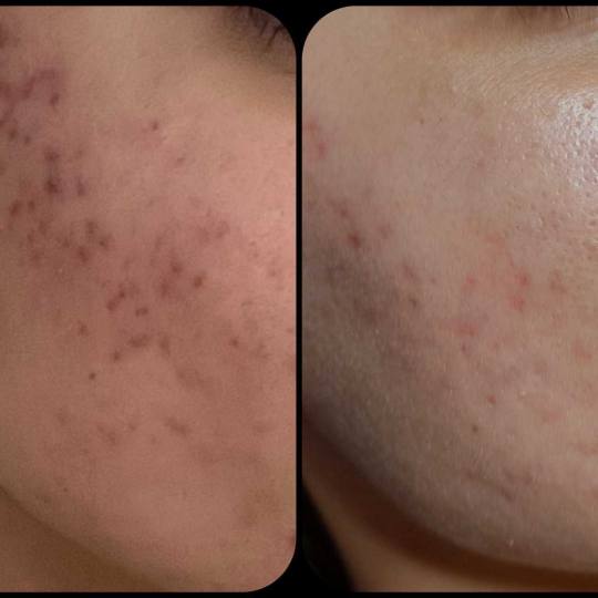 Natural #rijeka Lifting / zatezanje kože Dermapen - Microneedling Lifting / zatezanje kože