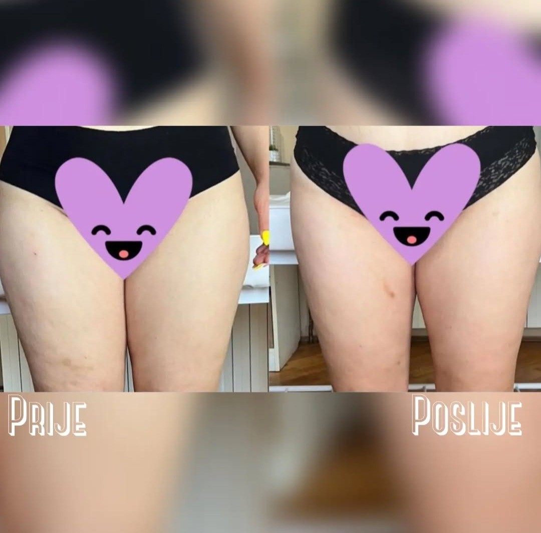 Posh Palace #velika-gorica Tretmani tijela Brazilska maderoterapija - noge + gluteus