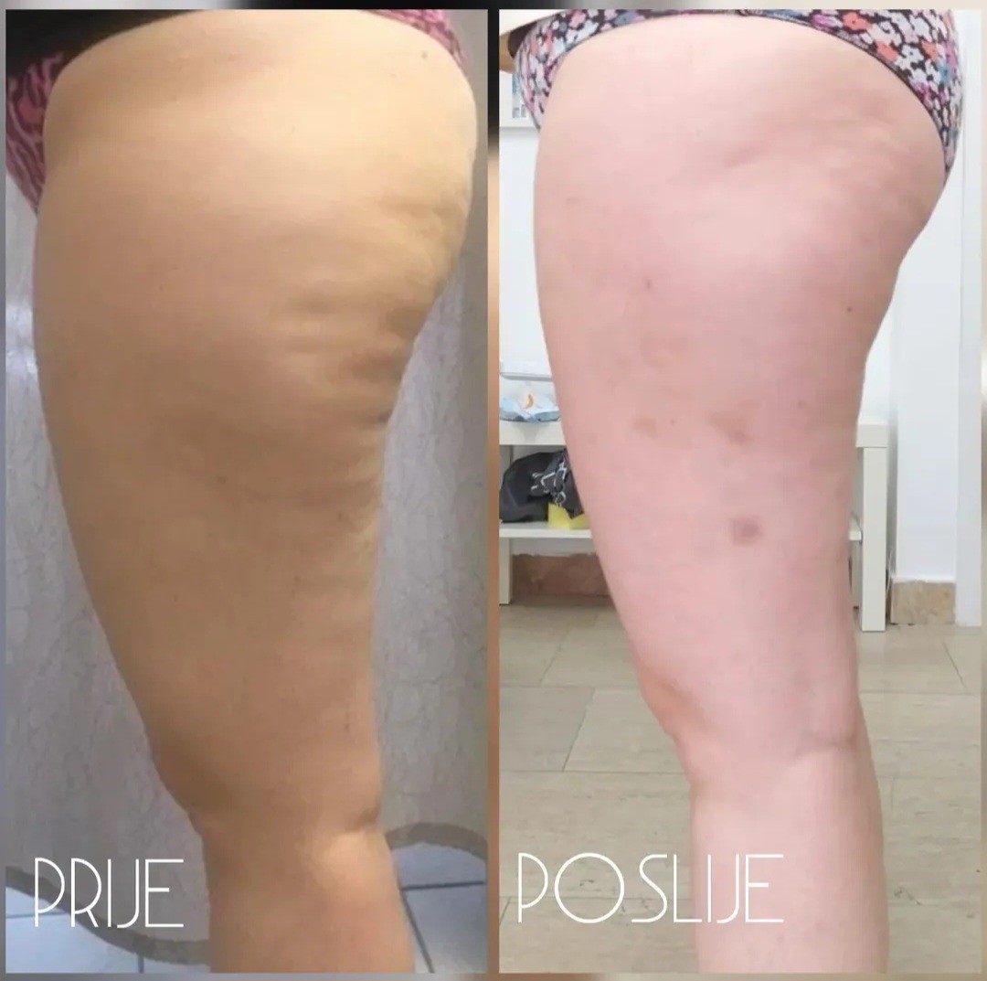 Posh Palace #velika-gorica Tretmani tijela Brazilska maderoterapija - noge + gluteus