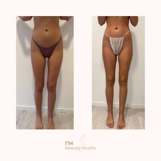 I'M beauty studio #zagreb Anticelulit Promo paket - 10x brazilska maderoterapija (noge gluteus 