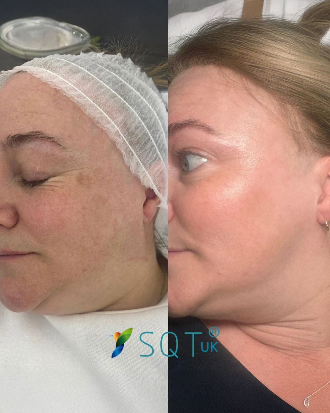 Luma Medic #zagreb Tretman lica SQT revitalizing