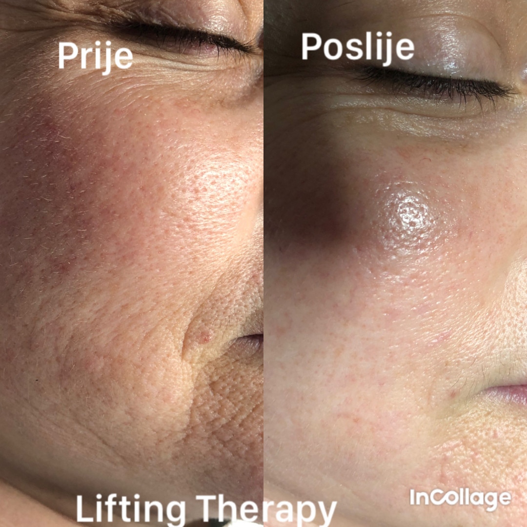 FeelUnique #zagreb Tretman lica Nana i Gaba lift therapy + microneedling - lifting / pomlađivanje