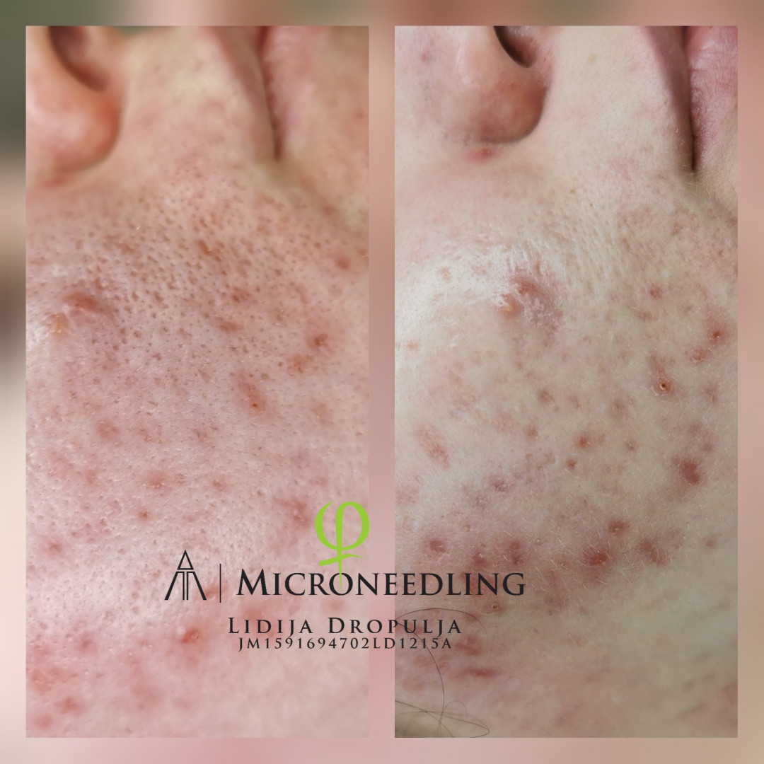 LD Beauty Centar #zagreb Mezoterapija lica Microneedling uklanjanje ožiljaka