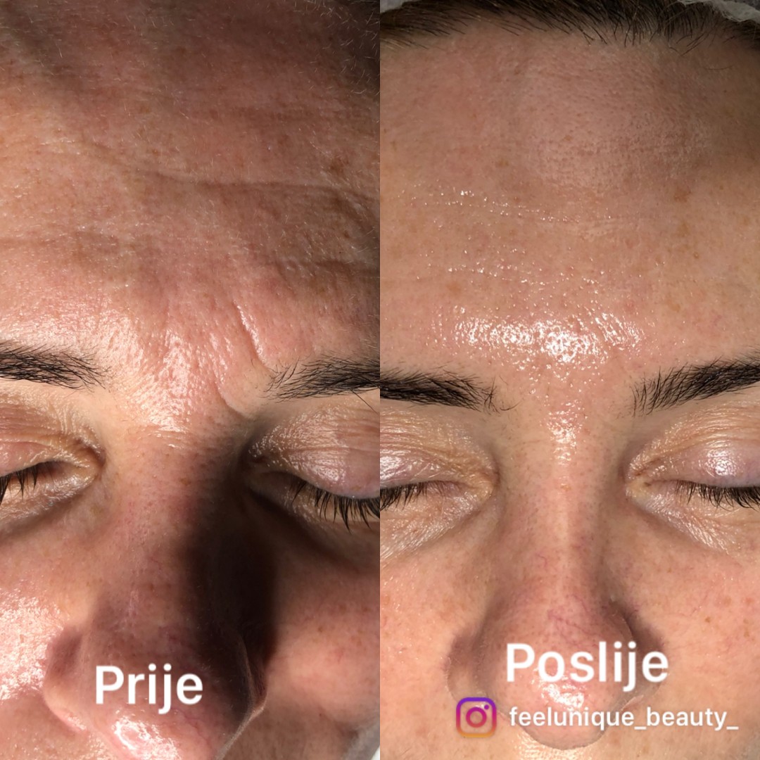 FeelUnique #zagreb Tretman lica Nana i Gaba lift therapy - lifting / pomlađivanje