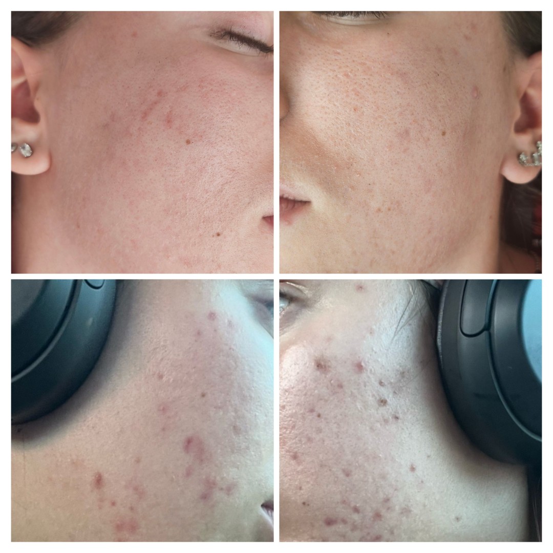 Medicinsko mehaničko čišćenje lica - problematična koža s akutnim upalnim stanjima - Cosmoderm & Centar Estetica, Zagreb Akne Lice Akne, Zagreb, Trnje