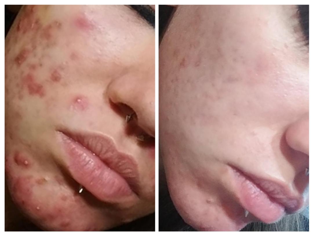 Medicinsko mehaničko čišćenje lica - problematična koža s akutnim upalnim stanjima - Cosmoderm & Centar Estetica, Zagreb Akne Lice Akne, Zagreb, Trnje