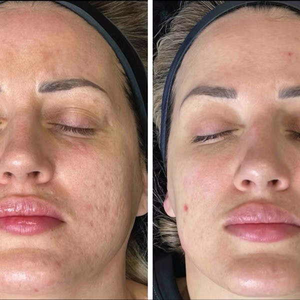 Microneedling lica - Glam Lab, Zagreb Mezoterapija lica Lice Mezoterapija lica, Zagreb, Donji grad - Centar