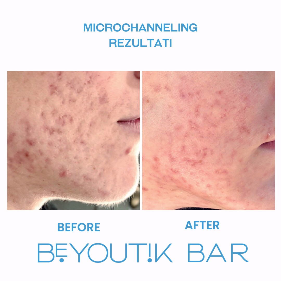BeYoutik Bar #zagreb Tretman lica Microchanneling - lice