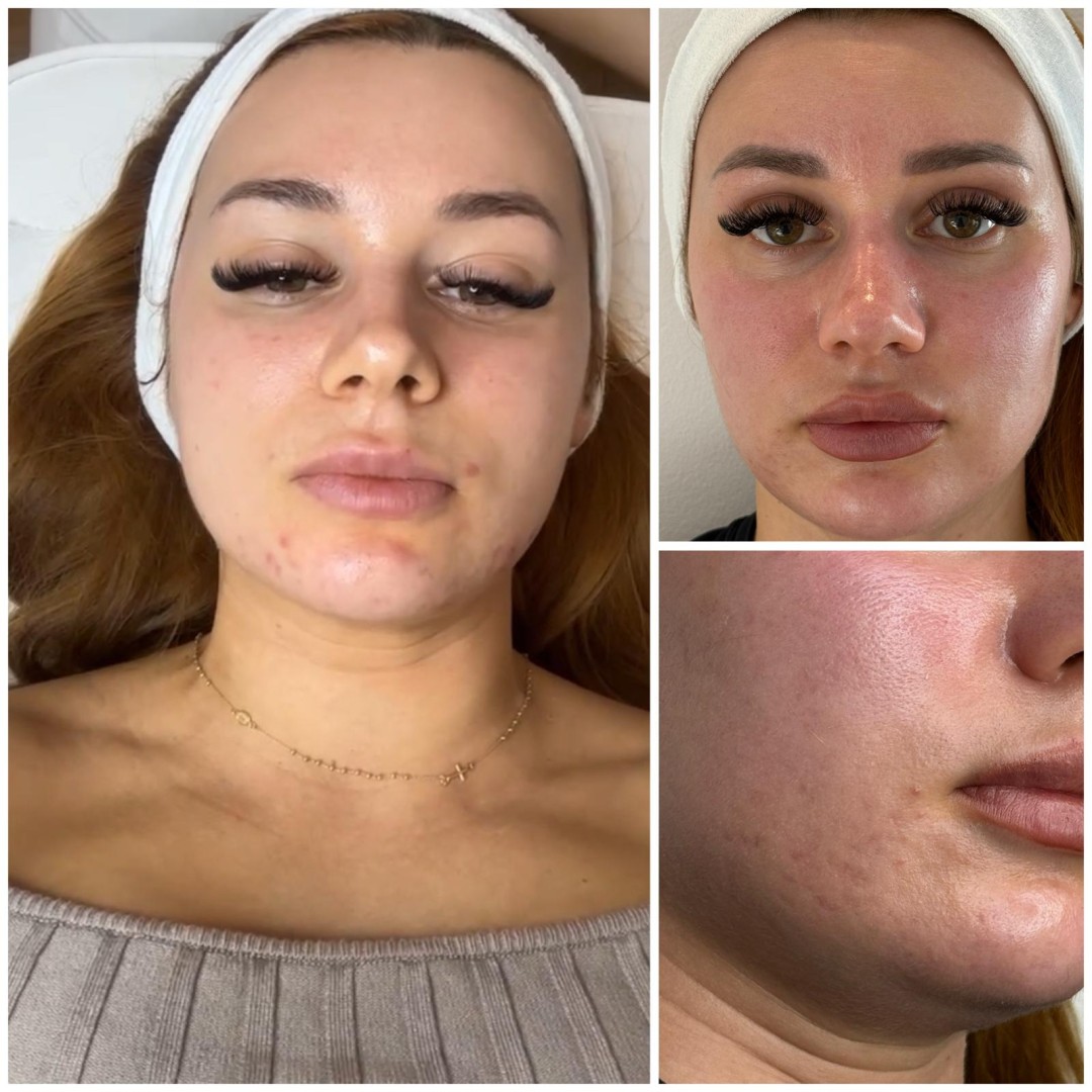 Silk skin #zagreb Piling lica Kemijski piling lica - Clear