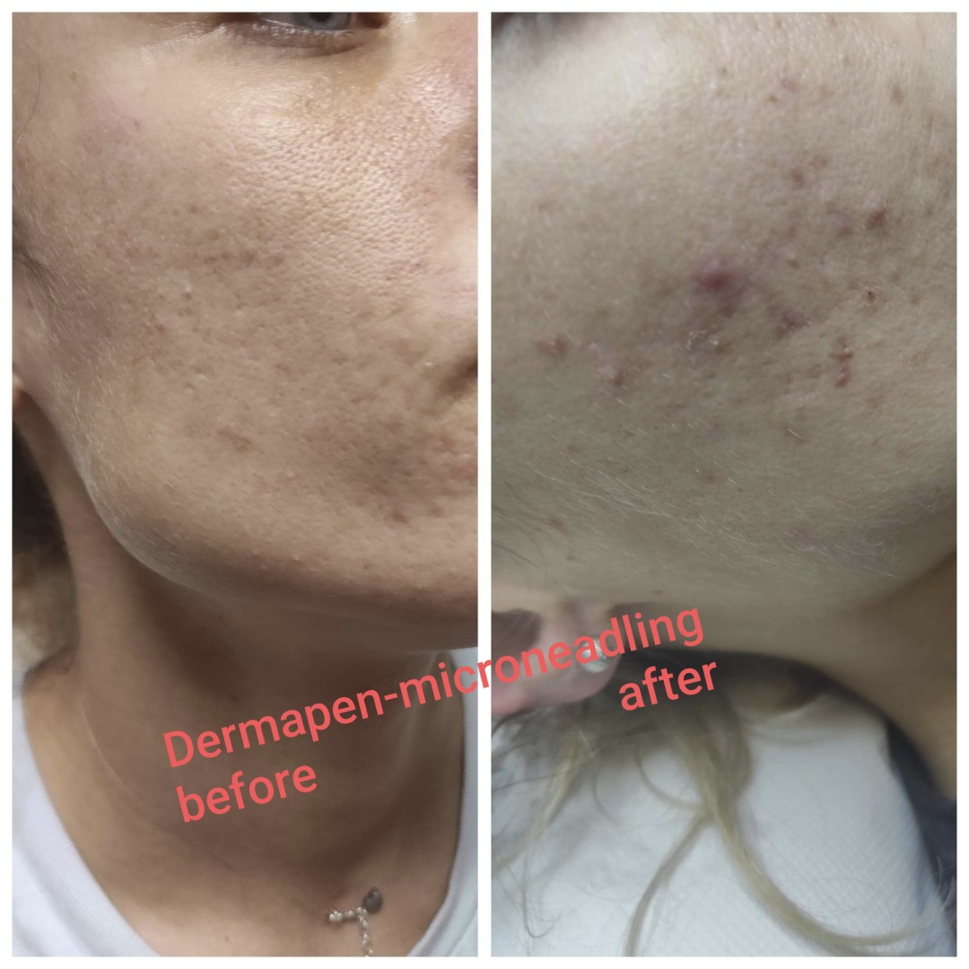 BioLaser Studio Rijeka #rijeka Tretman lica Dermapen aplikacija mezoterapijskih koktela