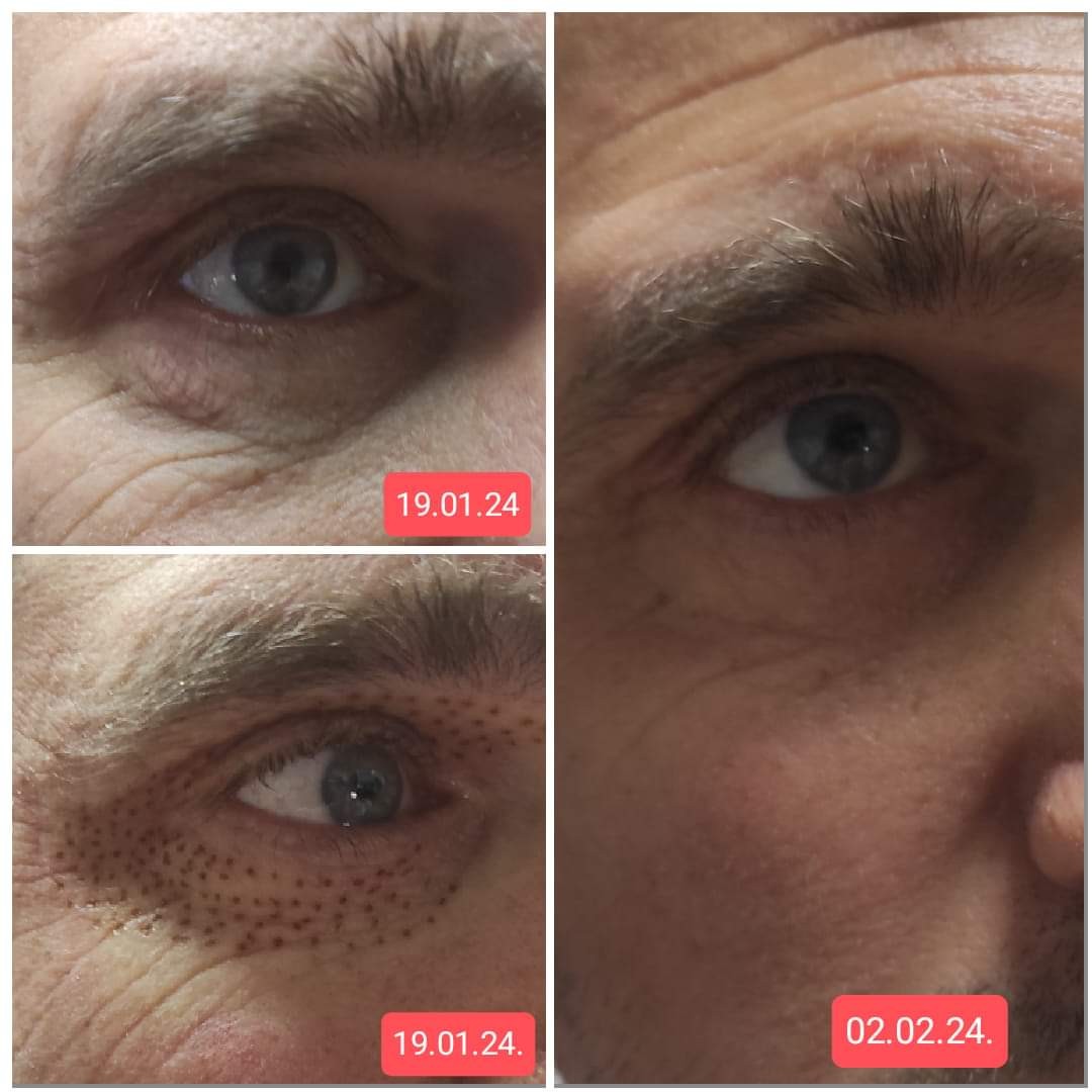 BioLaser Studio Rijeka #rijeka Tretman lica Plasma pen - gornji kapci