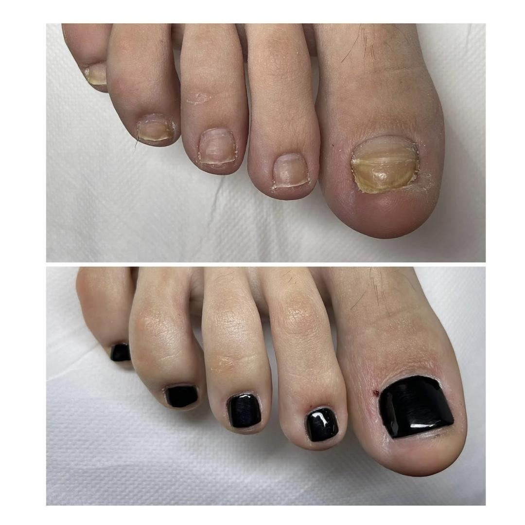 Glam Lab #zagreb Medicinska pedikura Medicinska pedikura