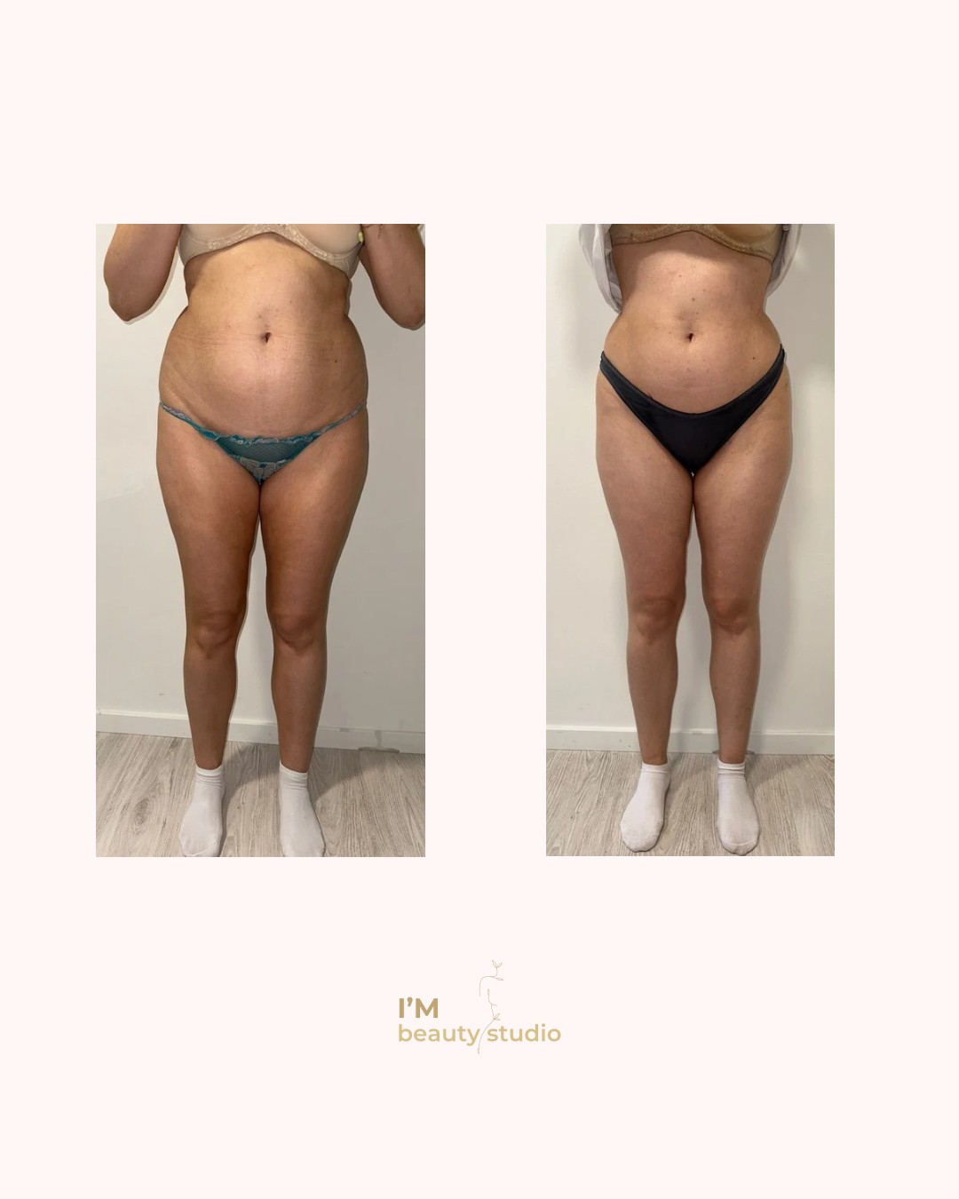 - I'M beauty studio, Zagreb Anticelulit Tijelo Anticelulit, Zagreb, Trešnjevka – sjever