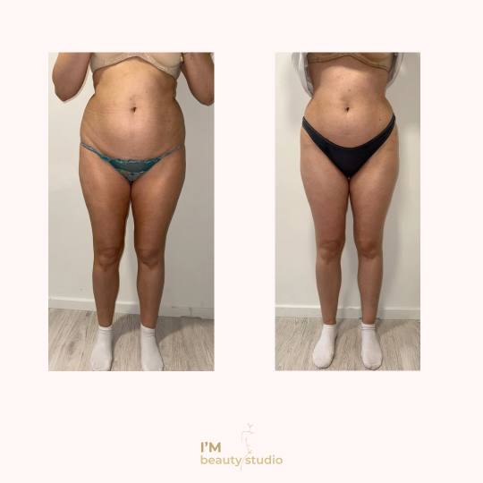 I'M beauty studio #zagreb Anticelulit