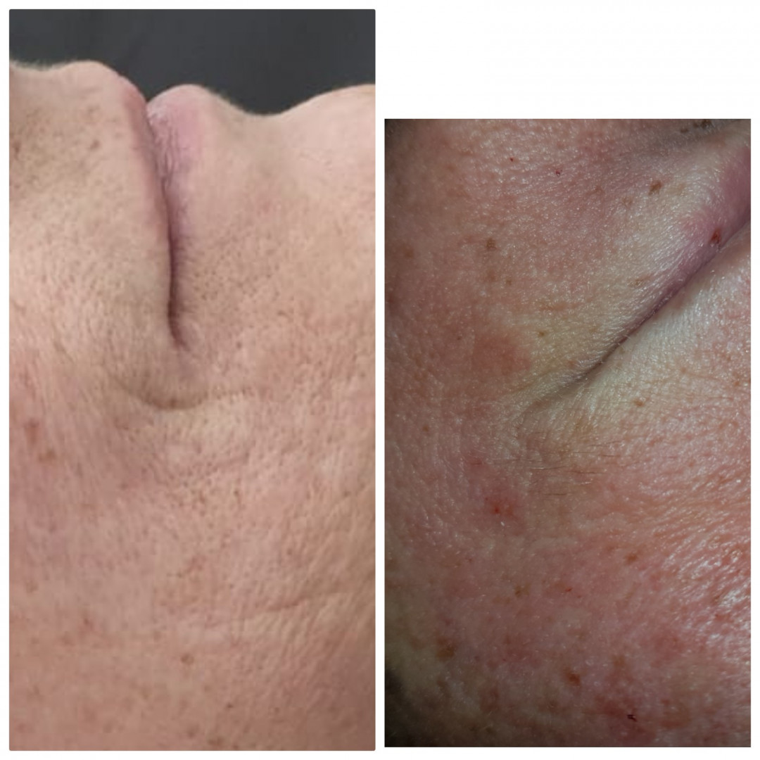 Melanis i Silueta studio za njegu lica i tijela #zagreb Tretman lica Mezoterapija lica + dermaroler - 5 tretmana