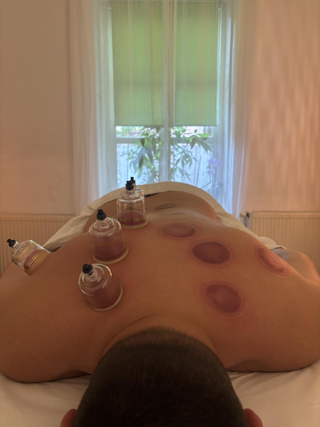 Corpus Sanum #zagreb Tretmani tijela Cupping terapija parcijalna