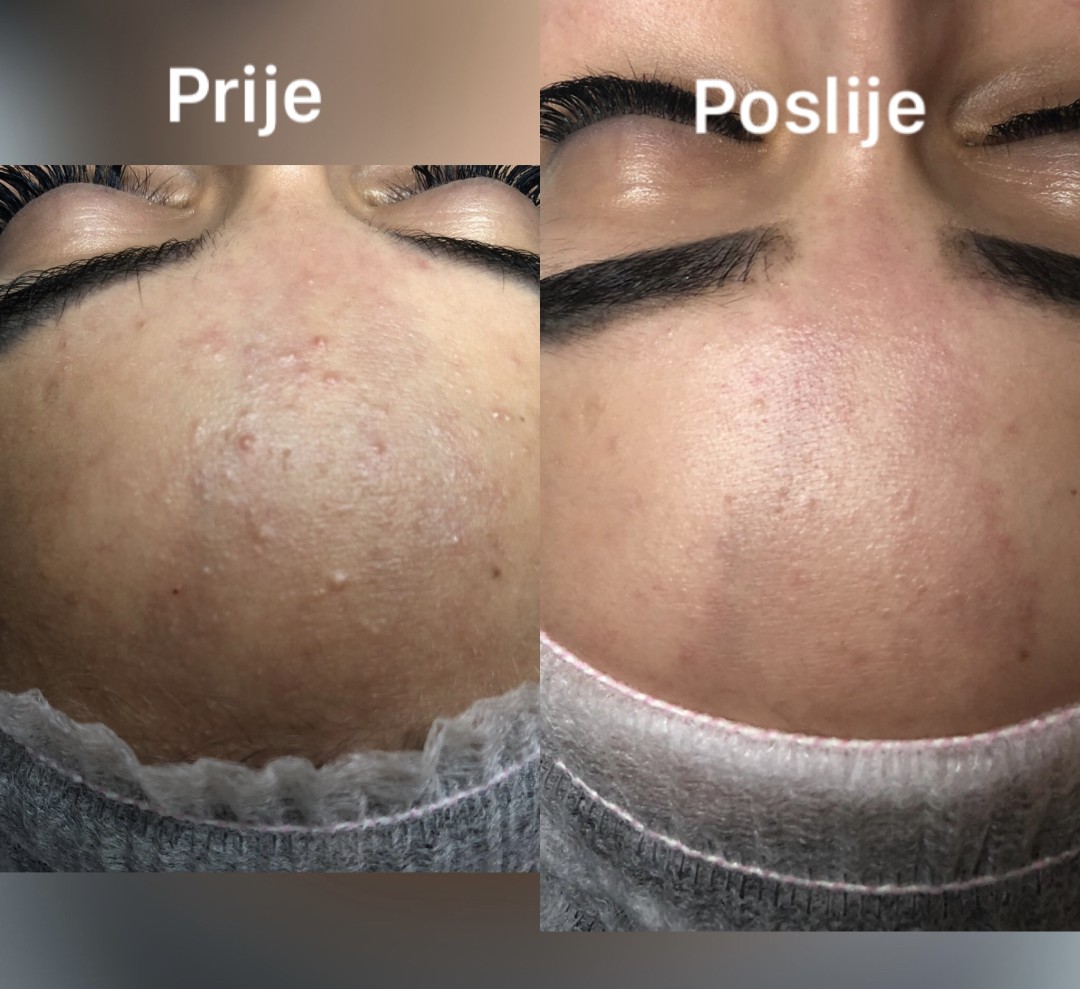 FeelUnique #zagreb Tretman lica Azac - tretman za masnu kožu sklonu aknama