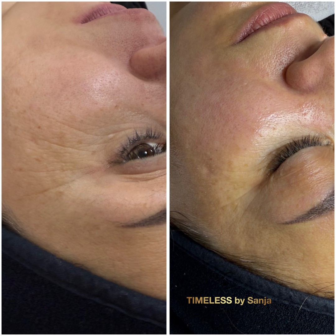 InspiraMed medi lift - Timeless by Sanja, Zagreb Tretman lica Lice Tretman lica, Zagreb, Peščenica – Žitnjak