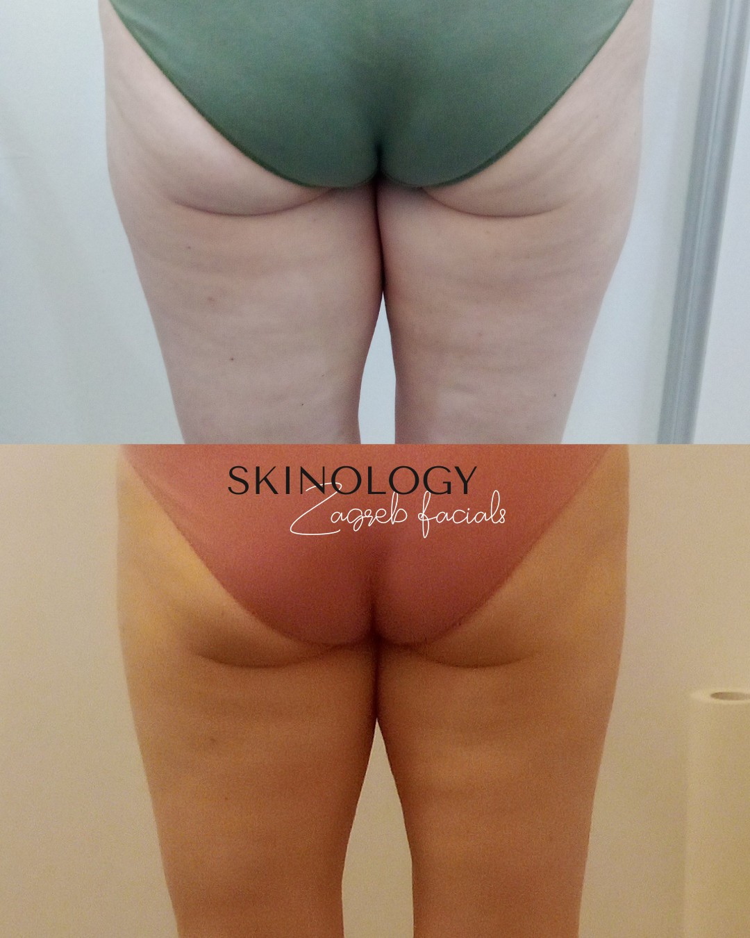 Skinology Zagreb facials #zagreb Tretman lica LPG aparativni anticelulitni tretman - paket od 10 tretmana + 1gratis