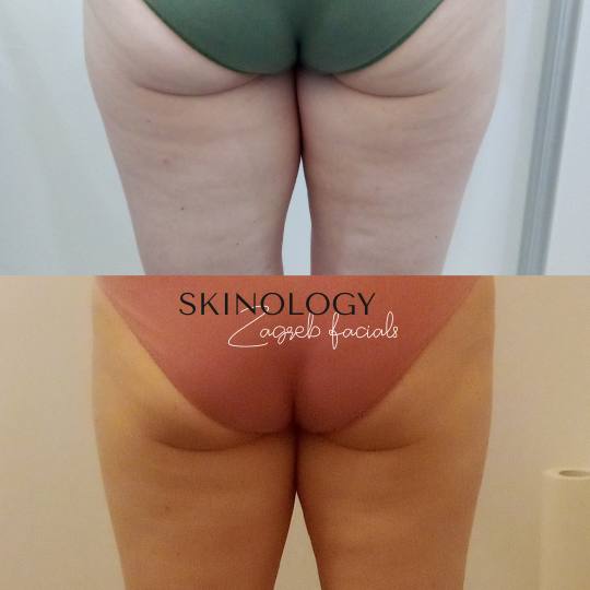 Skinology Zagreb facials #zagreb Tretman lica LPG aparativni anticelulitni tretman - paket od 10 tre