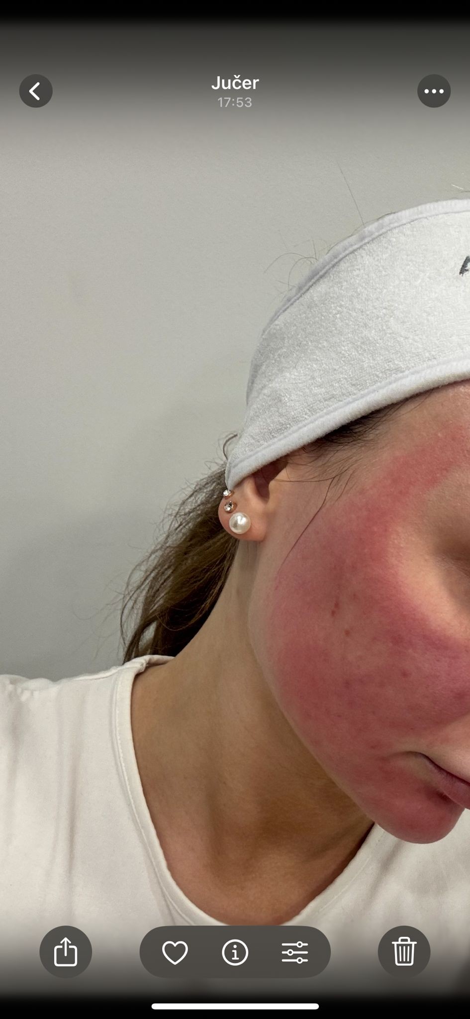 Aura - Zagreb #zagreb Dermaroler i dermapen Dermapen lica