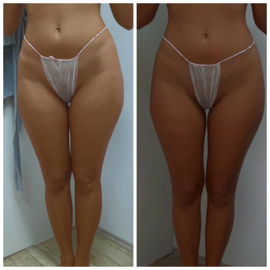 Melanis i Silueta studio za njegu lica i tijela #zagreb Masaža cijelog tijela Maderoterapija - cijele noge, guza, trbuh - 10 tretmana sa skockicom