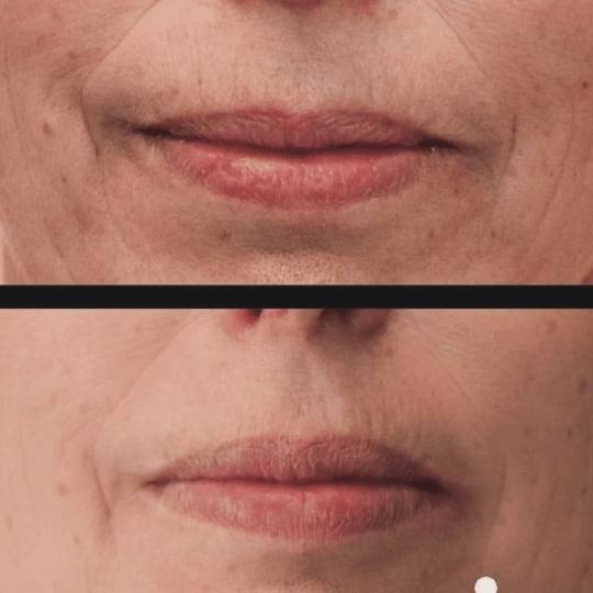 Antiage beauty room Lady Goga #zagreb Tretman lica