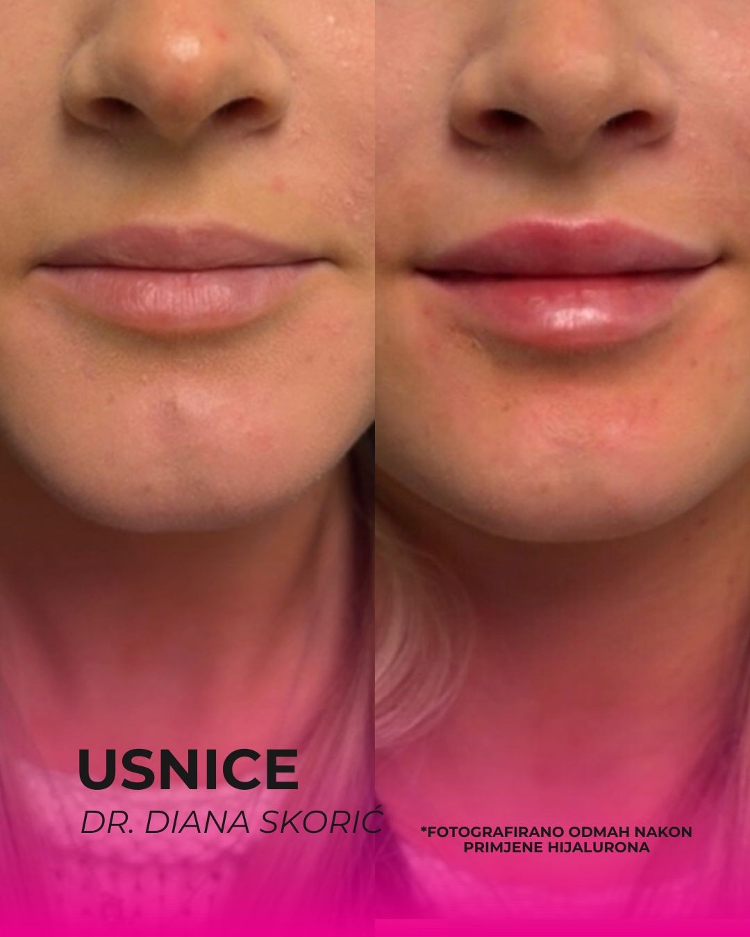 Ordinacija Diana Skorić #rijeka Hijaluronski tretmani lica Hijaluronski dermalni fileri - 1ml