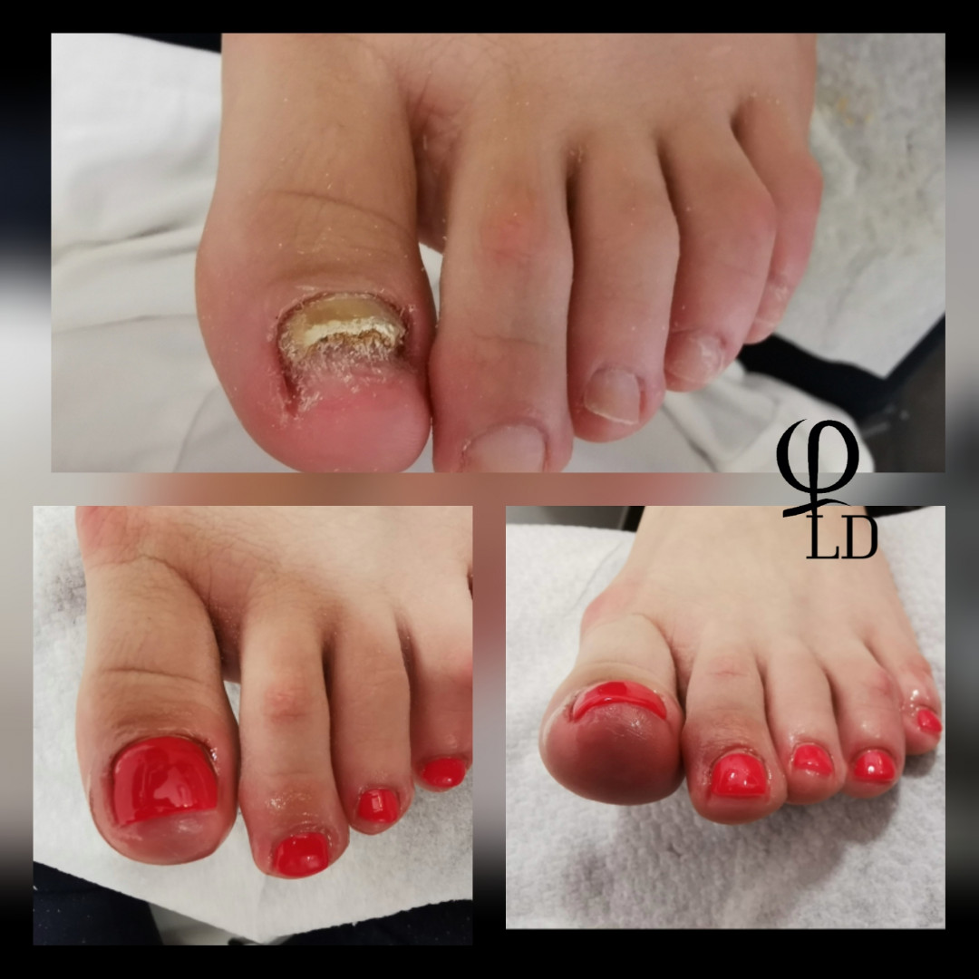 LD Beauty Centar #zagreb Estetska pedikura Rekonstrukcija nokta ( PUKNUĆE )