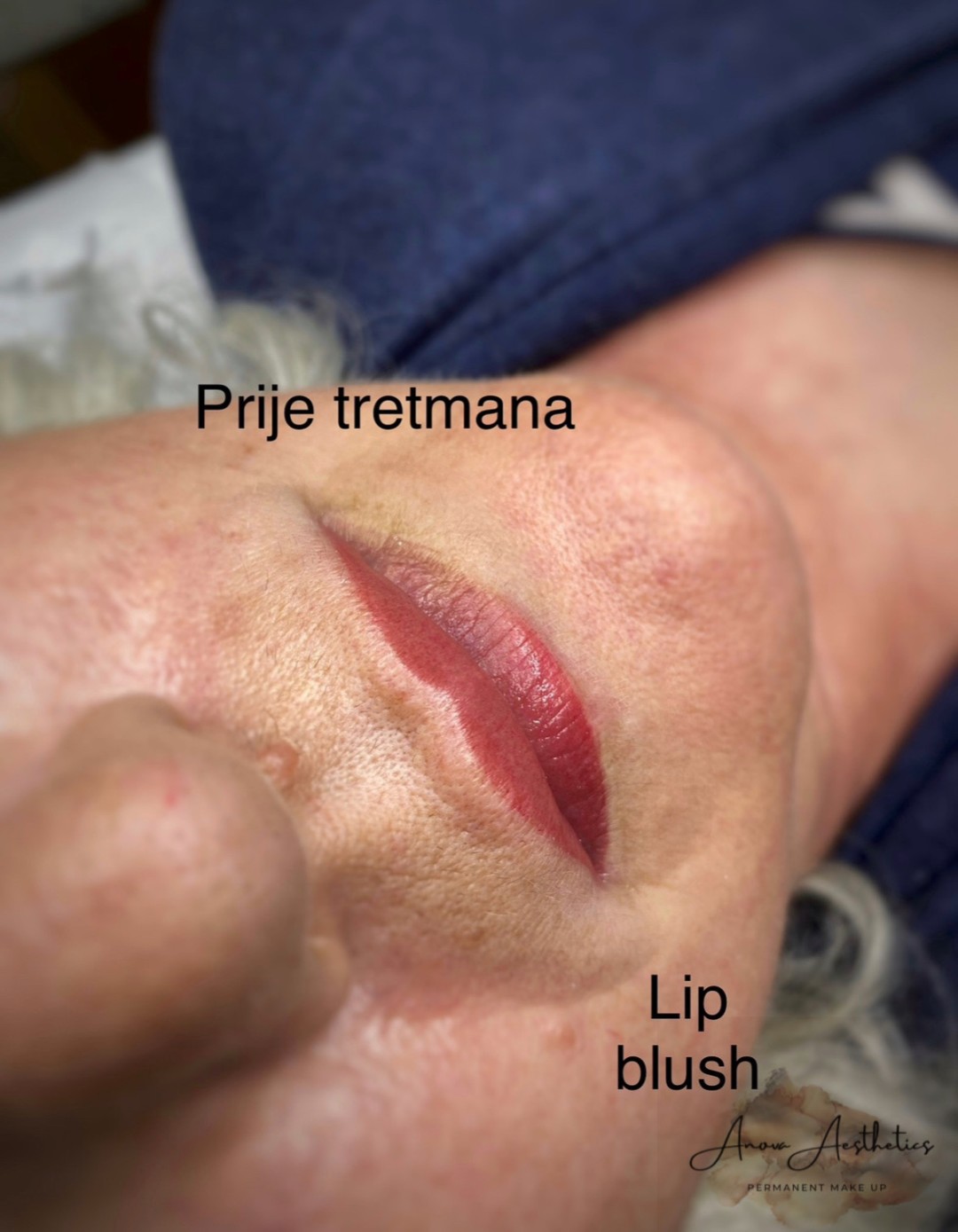 Trajna šminka - usne - Anova Aesthetics, Zagreb Trajna šminka Lice Trajna šminka, Zagreb, Trešnjevka – jug