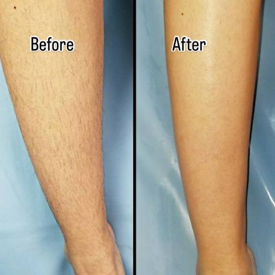 Angela #zagreb Laserska epilacija Laserska epilacija cijelih nogu - za dame Lasersko uklanjanje dlak