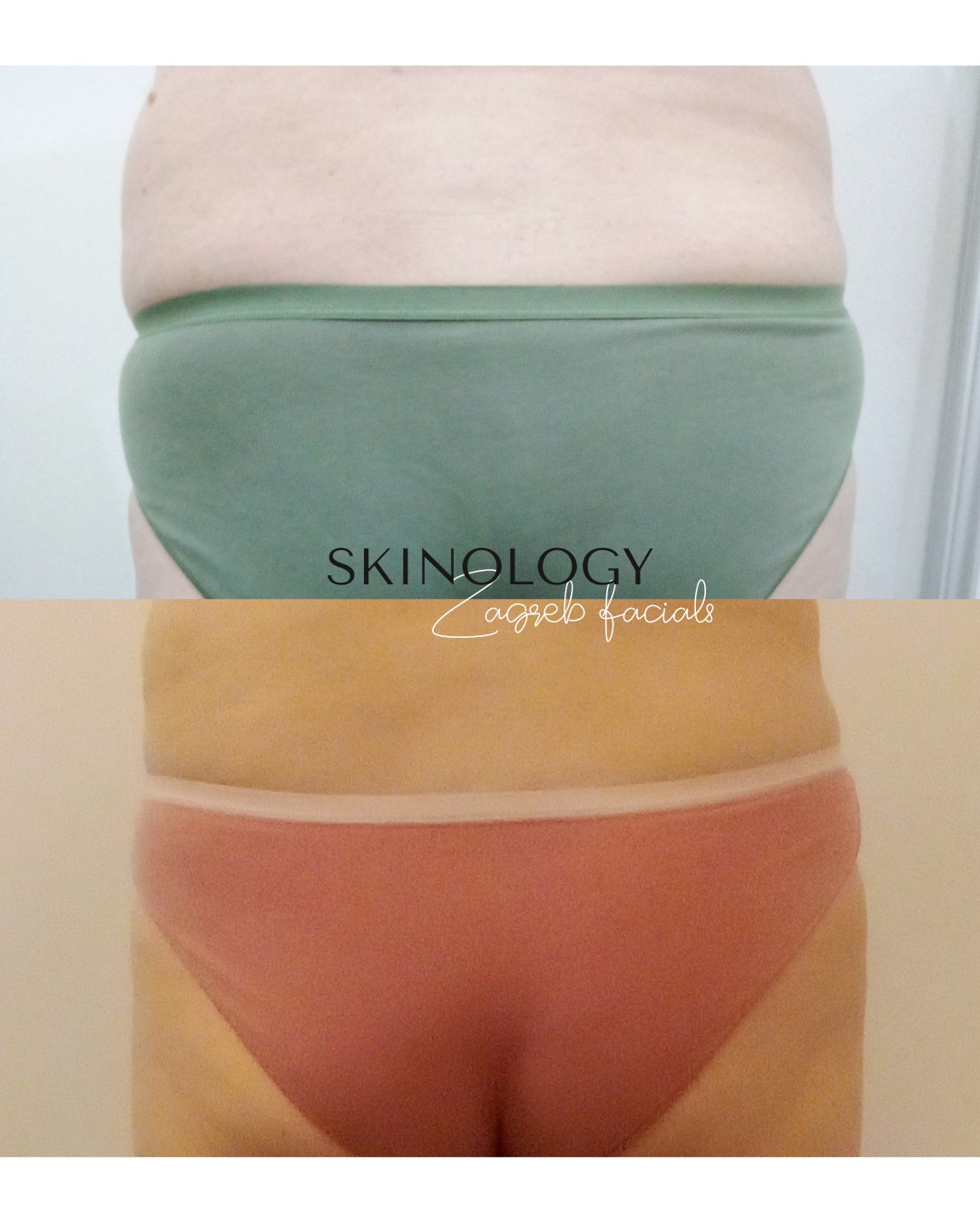 Skinology Zagreb facials #zagreb Tretman lica LPG aparativni anticelulitni tretman - paket od 10 tretmana + 1gratis