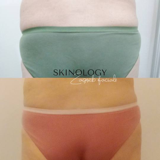 Skinology Zagreb facials #zagreb Tretman lica LPG aparativni anticelulitni tretman - paket od 10 tre